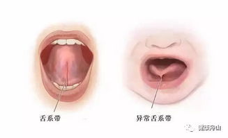 舌系带知多少