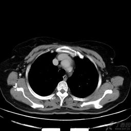 女,51岁,右胸背部疼痛2周,发热 乏力咳嗽一周 病理结果已公布 影像医学和核医学讨论版 