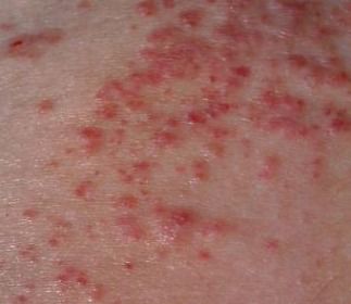 慢性湿疹的症状有哪些 
