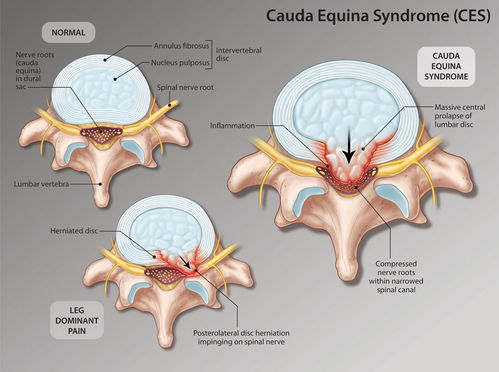 腰椎间盘突出症还要认识马尾神经综合征的危害