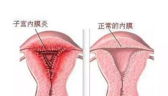子宫内膜的正常厚度 子宫内膜正常厚度是多少
