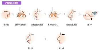 武汉矫正驼峰鼻手术怎么做