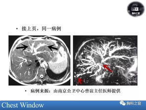 腹部结核的影像学诊断