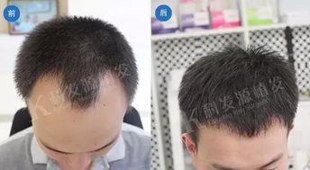 专家教你治疗发际线和两额角脱发的最好方法