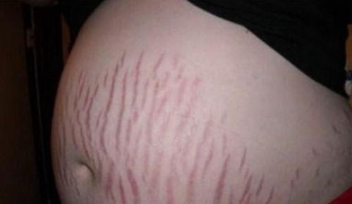 妊娠纹，什么是妊娠纹