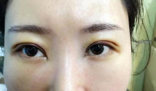 变双眼皮,双眼皮的改变：双眼皮手术的原理和过程