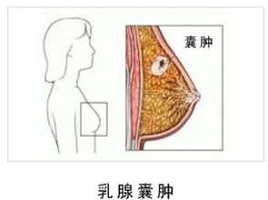 乳腺囊肿的治疗方法和注意事项