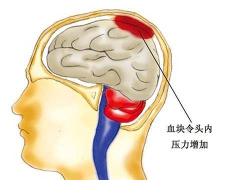 脑出血 不是老年人的专利 年仅25岁的B站员工因脑出血猝死