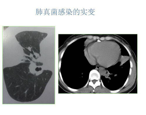 上蔡协和医院 胸片 胸部CT影像解读 支气管镜的临床应用培训