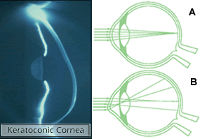 cross linking cornea,Cross Linking Cornea: A Comprehensive Guide