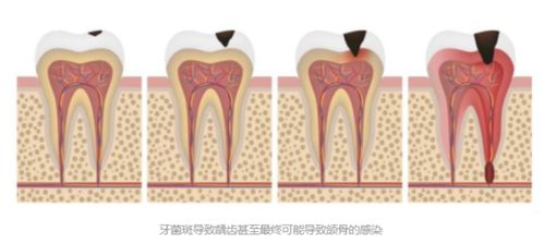 电动牙刷真的有用吗 口腔师深度总结电动牙刷优缺点