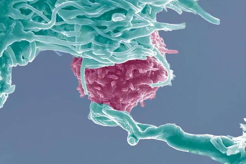 所有癌细胞都有可能转移吗 癌细胞转移后如何治疗
