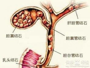 微创胆结石手术能自己在家换药吗