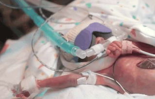 早产儿离开母体独自存活107天, 结果让人泪流