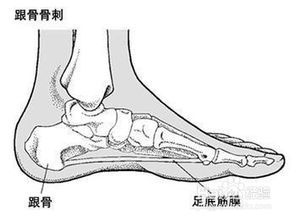 如何缓解骨刺痛 