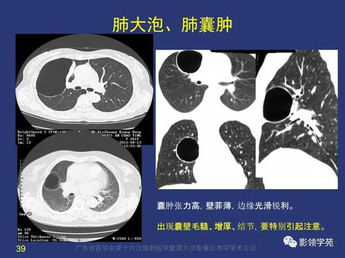 囊腔型肺癌的影像特征及鉴别