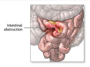 肠梗阻婴儿(小儿肠梗阻的征兆是什么)