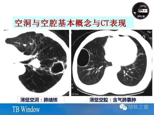 囊腔类肺癌的分型与CT表现