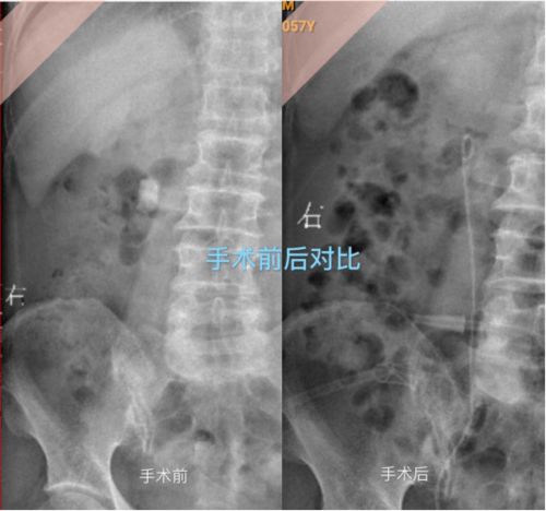 安溪县中医院 采用 石 光机技术 碎石效果 实打实