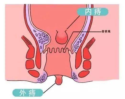 混合痔疮做手术行吗(混合痔疮做手术行吗能治好吗)