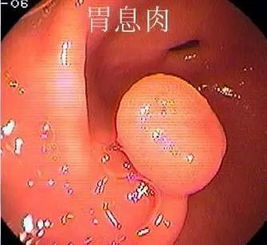 什么是胃部息肉