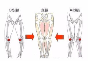 o型腿跑步会不会加重 