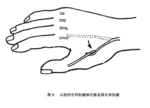 手部伸肌腱损伤详情页,手部伸肌腱损伤哪家医院看得好 治疗手部伸肌腱损伤哪个医生好 手部伸肌腱损伤推荐医院医生 微医 