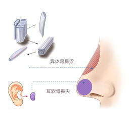 异体骨和超肋哪个好(超体和异体骨哪个好)