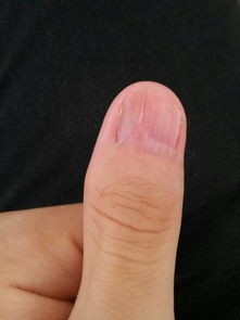 这个手指头怎么才能弄正常的模样 这是在一岁前弄的,具体不清楚,已经十几年了 现在看着感觉不好看想弄 