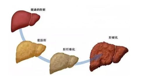 保护肝脏除了少喝酒以外,还要做好这几件事