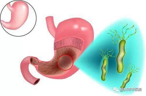 吹一口气 让幽门螺旋杆菌无处藏身