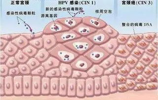 体检发现HPV阳性,心慌 害怕 如何是好...... 