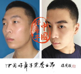 北京黄寺整形医院,隆鼻手术效果可以维持多长时间 