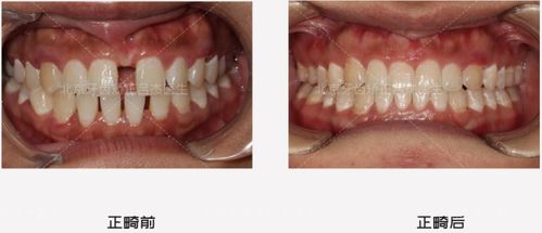 北京牙齿矫正 天生牙缝大,隐适美1.5年关闭牙缝