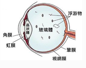 飞蚊症的原因有哪些？