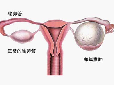 女性卵巢囊肿怎么回事