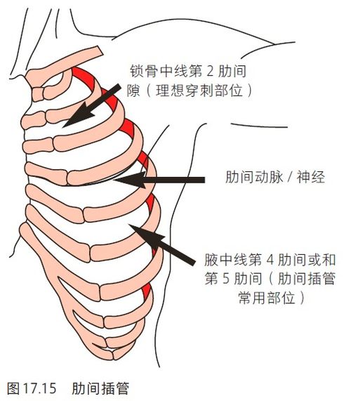 气胸的治疗策略有哪些 一文带你了解