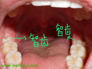 为什么我会长智齿
