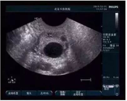 左侧卵泡1.76能怀孕么