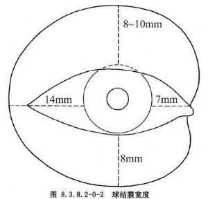 结膜松弛症手术