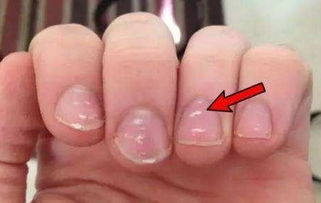 指甲上的月牙少 真的是不健康的表现吗