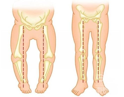 苏大附儿院小儿骨科科普 儿童行走内八字足和外八字足
