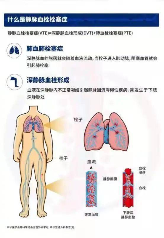 科普知识 警惕 沉默的杀手 静脉血栓栓塞症