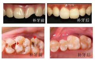 揭秘杭州补一颗牙要多少钱