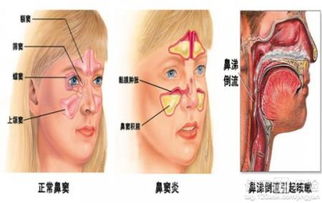 5岁孩子鼻窦炎怎么办，五岁的孩子为什么会犯鼻窦炎