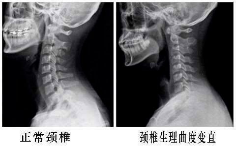 正常生理曲度 颈椎曲度变直 颈椎反弓 信息阅读欣赏 信息村 K0w0m Com