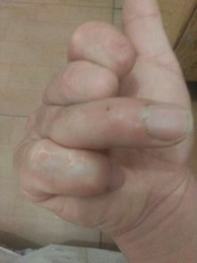 我手指是被机器轧掉的,食指少一节,中指少一节半,无名指是接的不能弯曲,小拇指伸不直 够级别办理残疾 