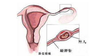 小心 宫外孕让你找不到宝宝 