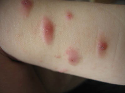 小儿丘疹性荨麻疹图片