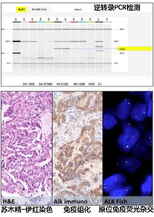 肺癌ALK基因检测阴性 可能方法错了 